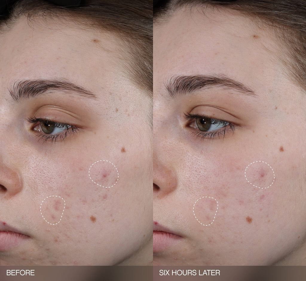 Patches for dark spots before-and-after showing visibly reduced acne marks on a fair-skin-tone model's cheek after just six hours of use.