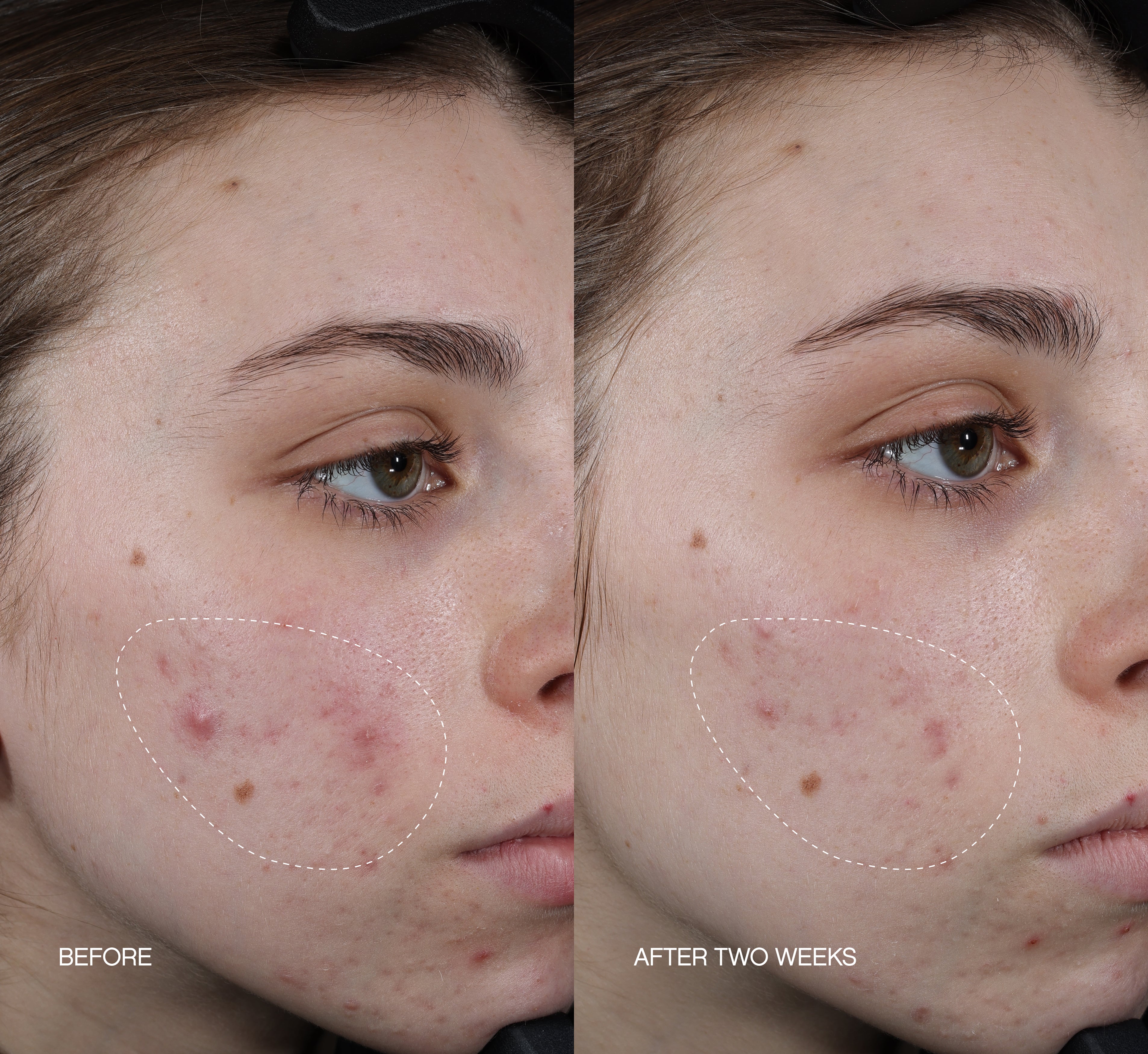 Before and after two-week comparison of acne dark spots on a cheek, with circled areas showing reduction from a serum for acne scars.