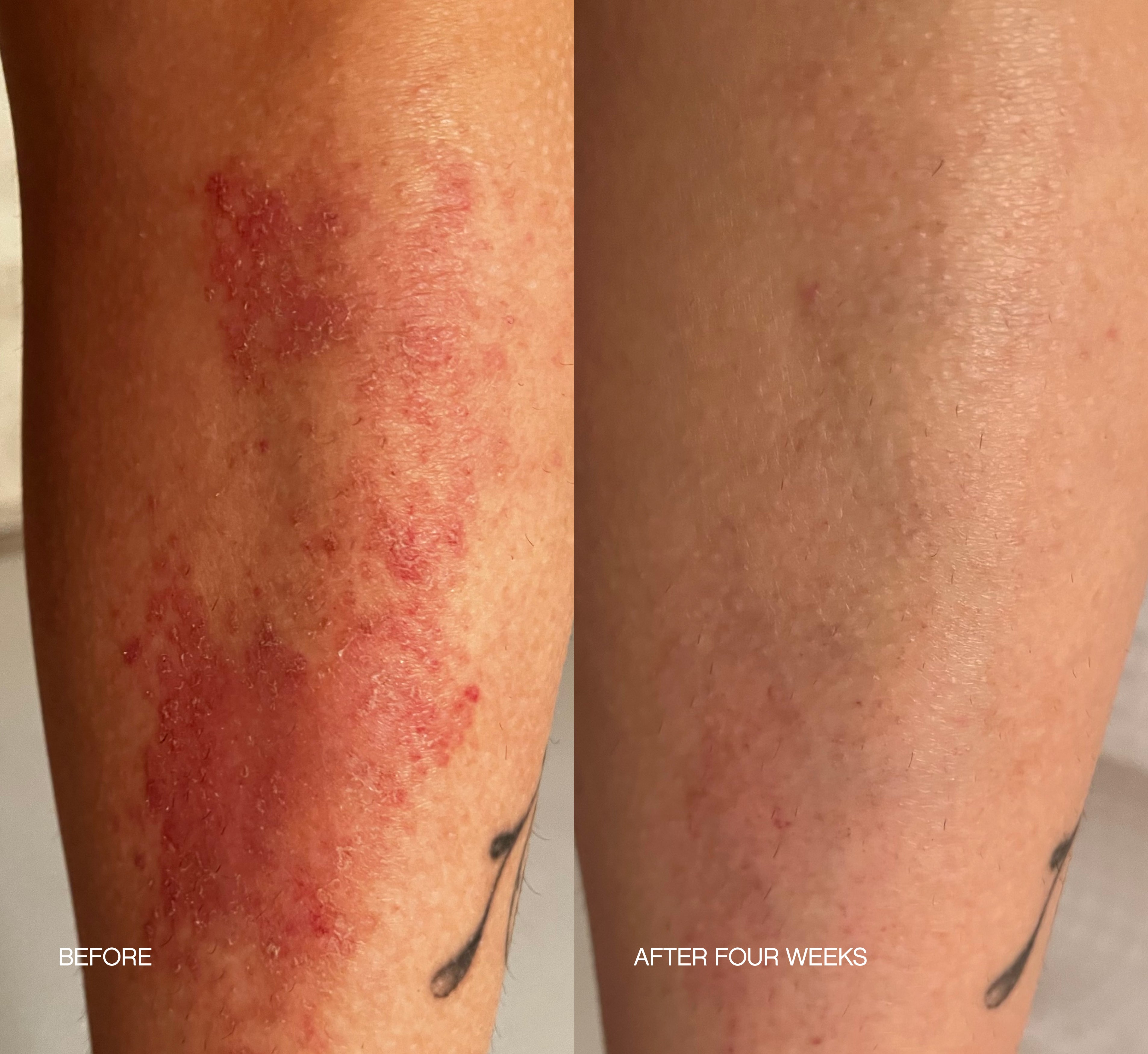 Before and after four-week comparison of an inflamed eczema rash on a leg, calmed and cleared after using Topicals Like Butter moisturizer for dry, sensitive skin.